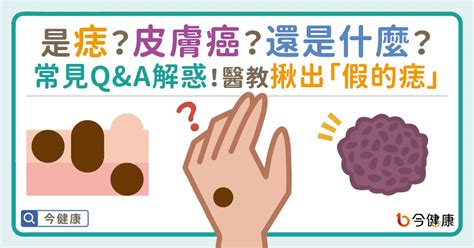 痣是凸的|是痣？皮膚癌？還是什麼？常見Q&A解惑！醫教揪出「。